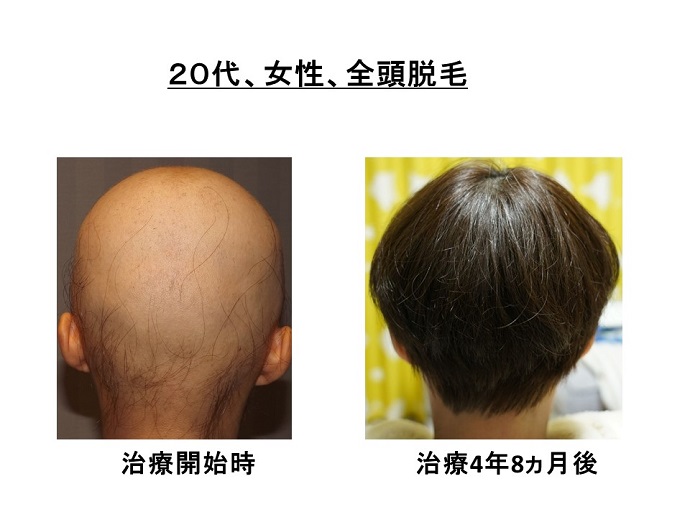 円形脱毛症　病院